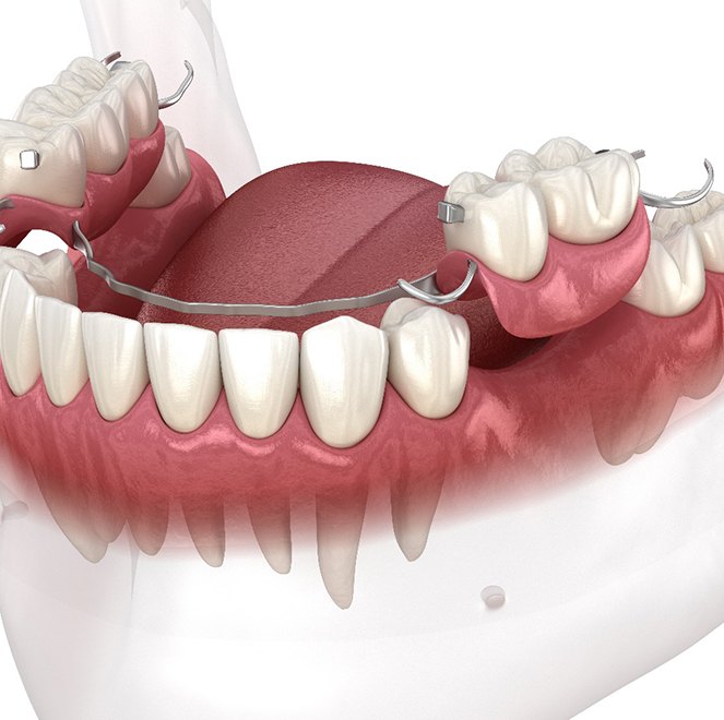 partial denture illustration with dentures in Jacksonville