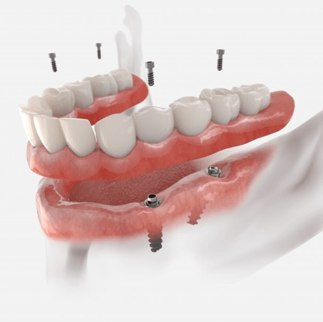 a digital illustration of an implant denture 