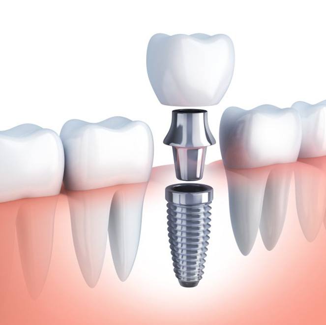 Diagram highlighting components of a dental implant in Jacksonville