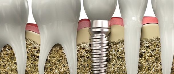 Diagram showing an integrated dental implant in Jacksonville