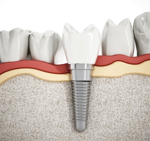 How Dental Implants Work Jacksonville Carlson Dental Group
