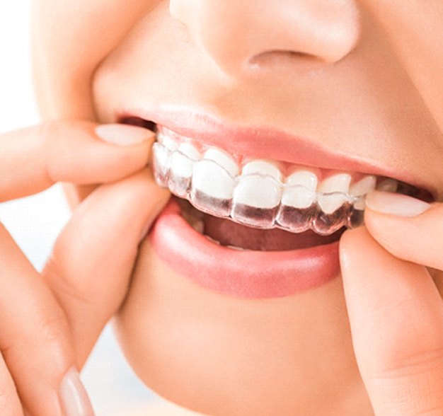 Close-up of woman placing Invisalign on upper arch
