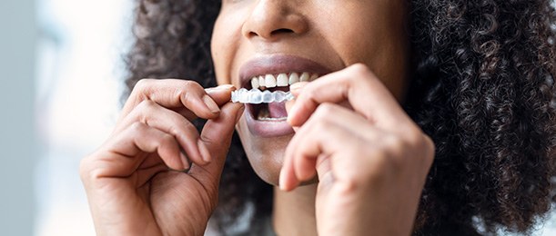 Closeup of patient putting on clear aligner