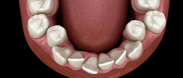 Illustration of crooked teeth