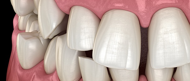 Illustration of gapped teeth