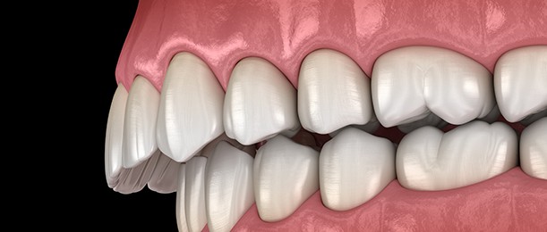 Illustration of an overbite