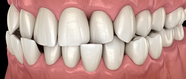 Illustration of a crossbite