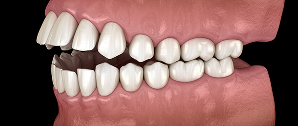 Illustration of an open bite