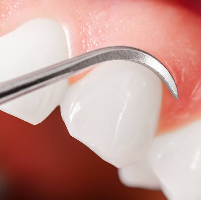 Smile during scaling and root planing