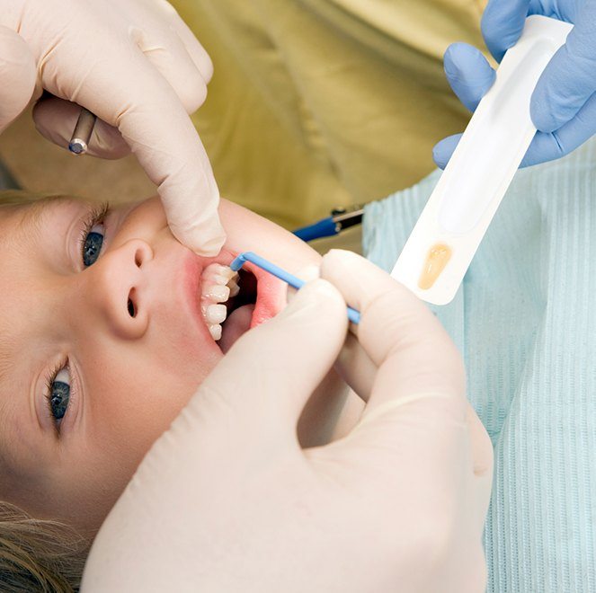 Child receiving fluoride treatment