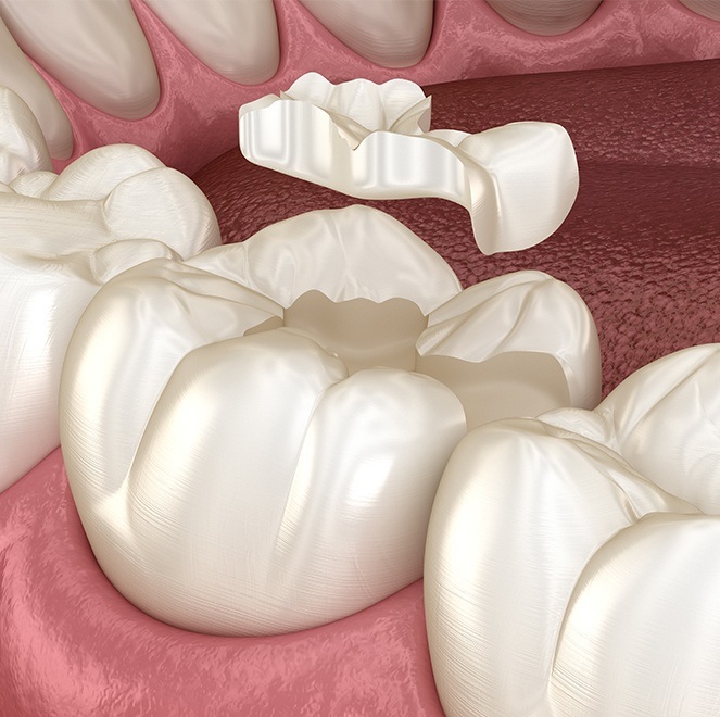 Animated closeup of smile receiving tooth-colored filling