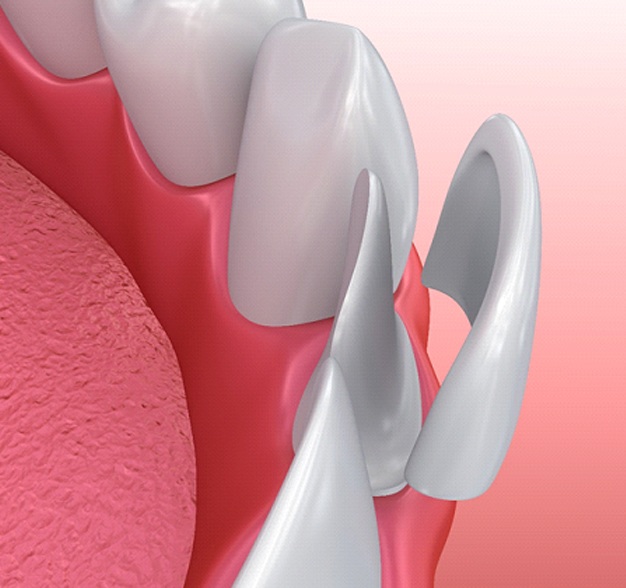 Veneers being placed on lower arch of teeth