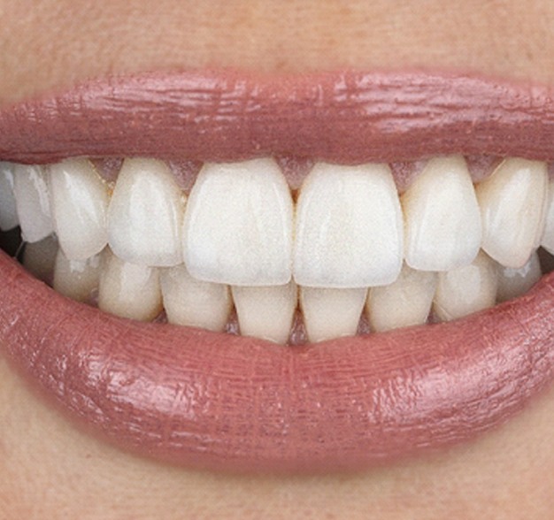 Close-up of a smile corrected with veneers