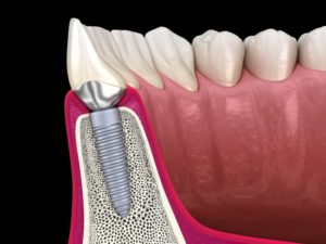 Illustration of dental implant integrated with surrounding bone